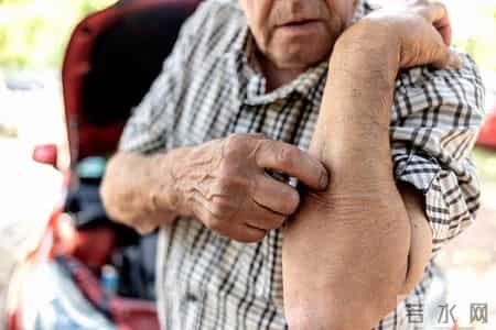 老年人皮肤瘙痒，记住这个乳膏，治疗皮炎、瘙痒症，丘疹性荨麻疹