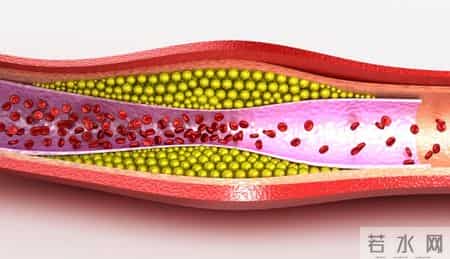 不是所有斑块都要吃药！医生：若报告上没有这5个字眼，大可放心