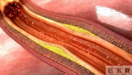 不是所有斑块都要吃药！医生：若报告上没有这5个字眼，大可放心