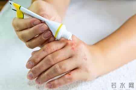 老年人皮肤瘙痒，记住这个乳膏，治疗皮炎、瘙痒症，丘疹性荨麻疹