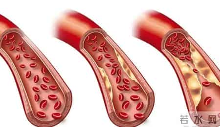 不是所有斑块都要吃药！医生：若报告上没有这5个字眼，大可放心