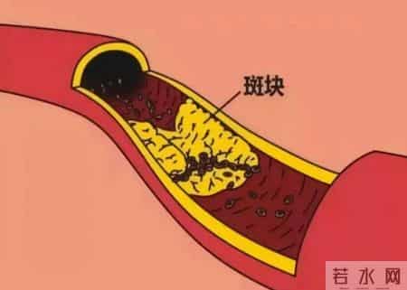 不是所有斑块都要吃药！医生：若报告上没有这5个字眼，大可放心