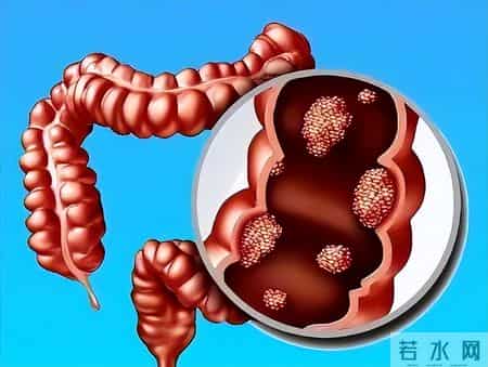 气温下降！提醒癌症病人，牢记：1不碰，2不洗，3要吃，速来！