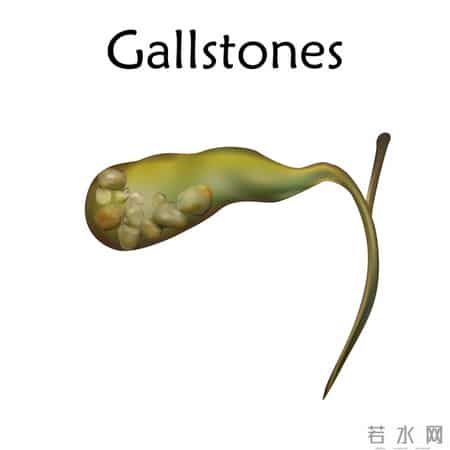 从胆结石到胆囊癌：48岁男子的3个致命错误，很多人都在犯！