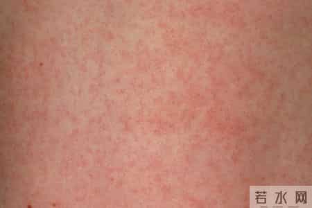 老年人皮肤瘙痒，记住这个乳膏，治疗皮炎、瘙痒症，丘疹性荨麻疹