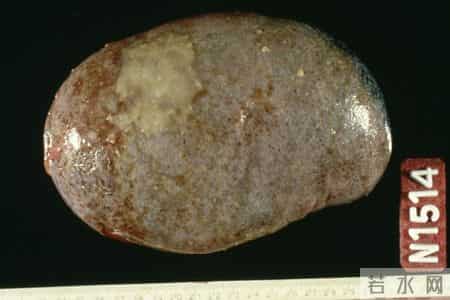 从胆结石到胆囊癌：48岁男子的3个致命错误，很多人都在犯！