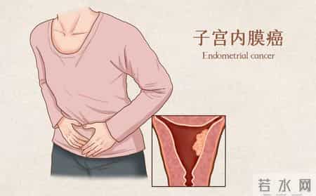 5天最少13次！46岁女子子宫内膜晚期，医生：反复强调，就是不听